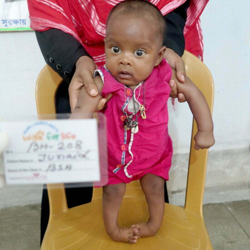 Aadin as a baby with bilateral clubfoot