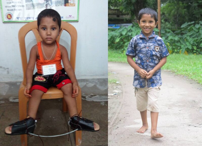 Left: Fahim wearing corrective shoes; Right: Fahim smiling and walking down a road